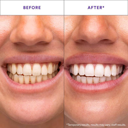 Whilux Toothpaste Foam™